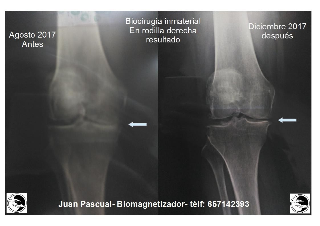 Biocirugía inmaterial